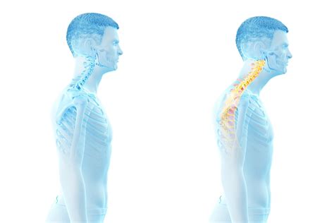 How to Correct Forward Head Posture | Greater Austin Pain Center