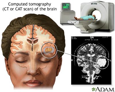 Migraine Information | Mount Sinai - New York