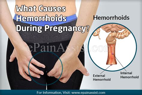 What Causes Hemorrhoids During Pregnancy & Know its Prevention and Treatment