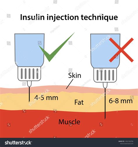 89 Insulin Injection Technique Images, Stock Photos & Vectors ...