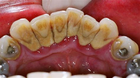 NATURAL TREATMENT: You Have Tartar On Your Teeth? Remove It Easy With This 4 Remedies
