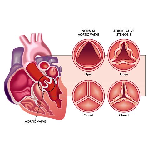 Aortic Valve Disease Causes And 2024 Insights | Vejthani