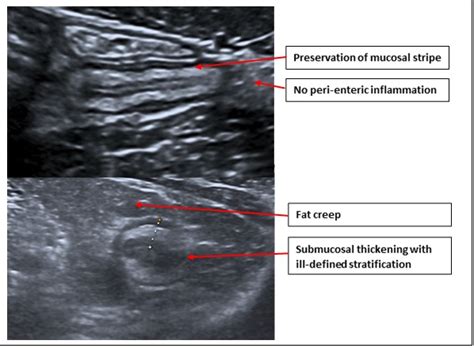 Bowel ultrasound | SoR