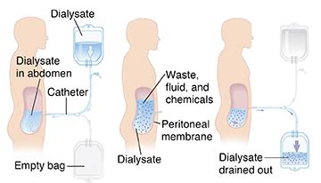 Peritoneal Dialysis (PD) | Saint Luke's Health System