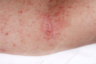 Eczema on the arm - Stock Image - C011/0369 - Science Photo Library