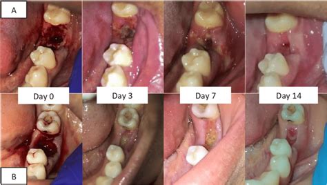 Tooth Extraction Healing Process Pictures