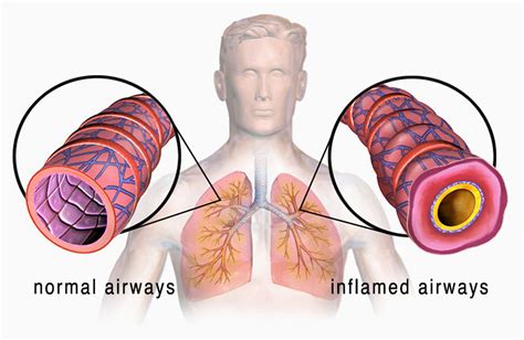 Asthma: Symptoms, Causes, Diagnosis and Treatment