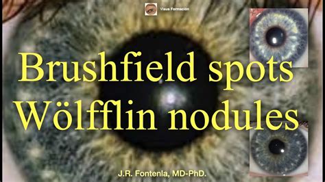 Brushfield spots. Wölfflin nodules. - YouTube