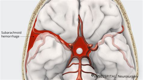 Ruptured aneurysm and subarachnoid haemorrhage | Neurosurgery Inselsptial Bern