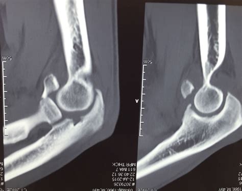 Sagittal plane CT scan showing the radial head fracture and anterior ...