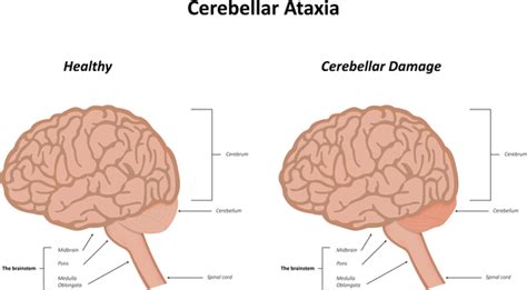 Ataxia in Childhood — Symptoms and Treatment | Medical Library