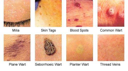 Warts - Definition, Symptoms, Types, Treatment And Prevention