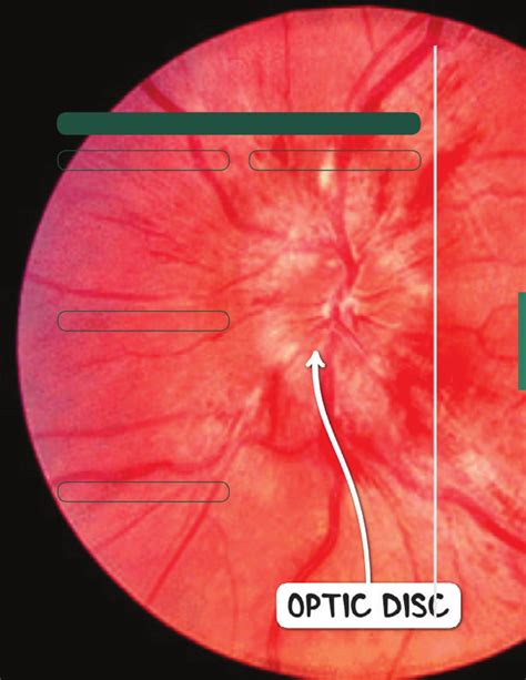 Increased intracranial pressure Notes: Diagrams & Illustrations | Osmosis