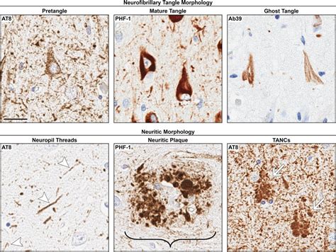 Visualization of neurofibrillary tangle maturity in Alzheimer's disease ...