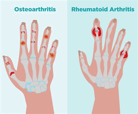 Osteoarthritis Vs Rheumatoid Arthritis Hands