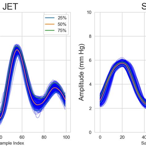 Cannon a wave is the primary CVP morphology during JET onset | Download Scientific Diagram