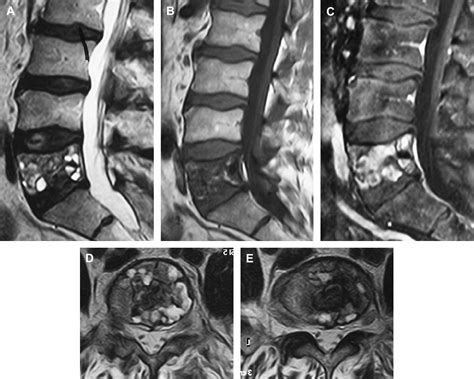 Aneurysmal Bone Cysts of the Spine - Neurosurgery Clinics