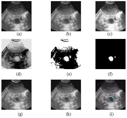 Follicle Detection and Ovarian Classification in Digital Ultrasound ...