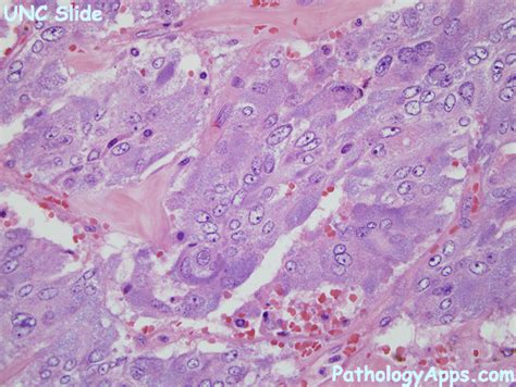 medullary carcinoma thyroid histology