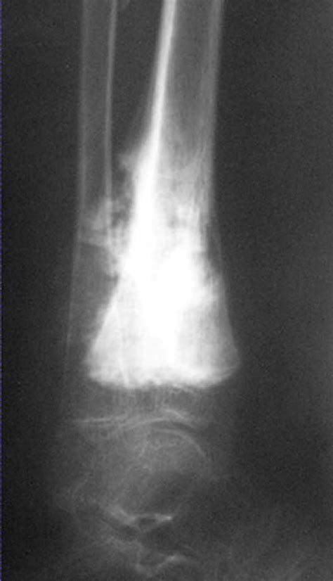 Typical 'sunburst' appearance as the tumor penetrates soft tissue as it ...