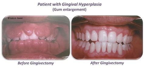 Gingival Hyperplasia (before&after) | Dr. Luis Ángel Cantú Aldrete