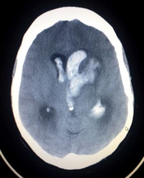 Intra-axial hemorrhage - wikidoc