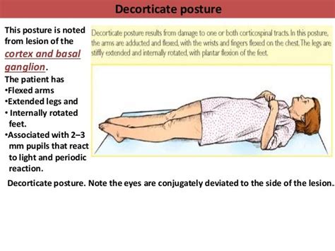 Decorticate Posturing Prognosis | Bruin Blog