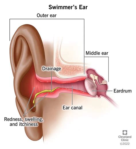 Otitis Externa: Causes, Symptoms, Diagnosis, And Treatment, 51% OFF