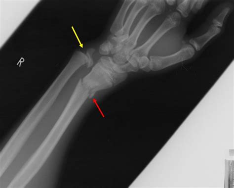 Salter-Harris fracture Type I – Radiology Cases