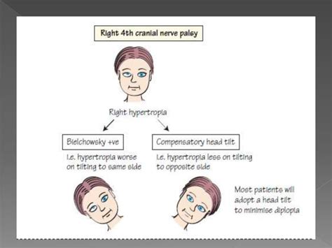 3rd, 4th, & 6th cranial nerve palsy