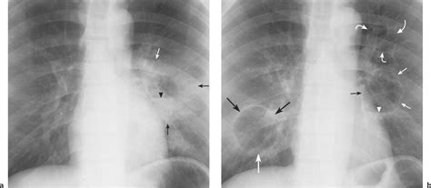 Pulmonary Cavitary and Cystic Lesions | Radiology Key