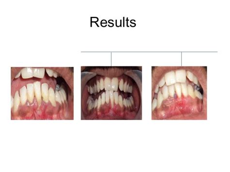 case report of Periosteal pedicle graft-novel technique