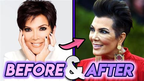 Kris Jenner | Before and After Transformations | Plastic Surgery ...