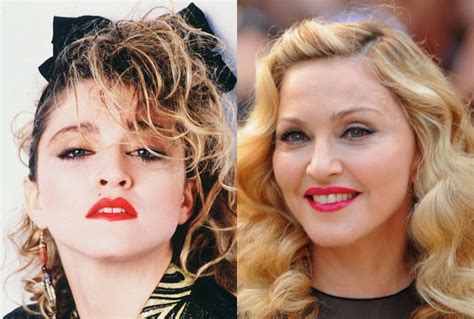 Madonna Before and After Plastic Surgery