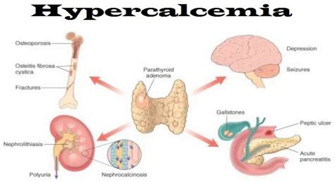 Hypercalcemia - Causes, Signs, Symptoms, Workup, Treatment