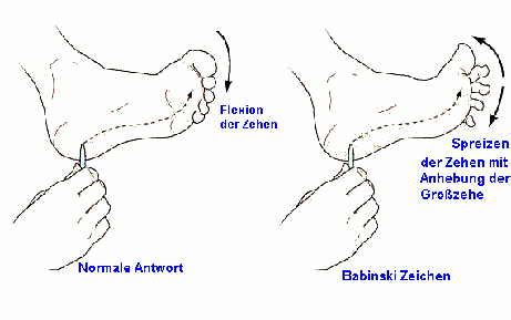 Babinski reflex. Causes, symptoms, treatment Babinski reflex