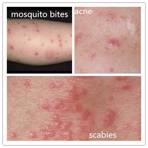 What Do Scabies Look Like? | New Health Advisor