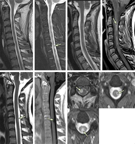 Cervical Spine Mri Ms