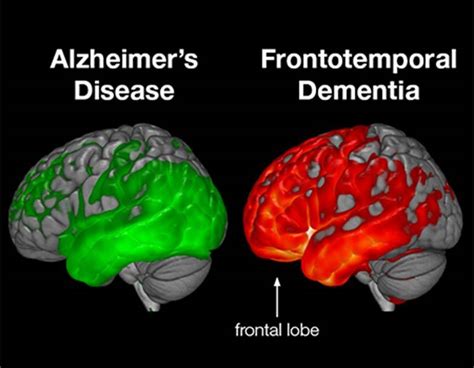 What is Frontotemporal Dementia?? - The Ruby Pardue Blackburn Adult Day Health Care Center