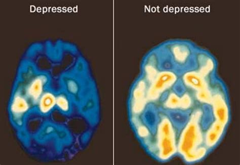 Brain Scans Show How TMS Treats Depression | Smart TMS