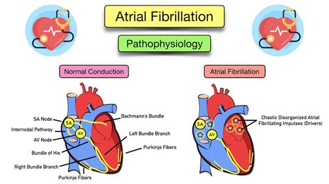 Atrial Fibrillation: Symptoms, ECG, Causes, Treatment, Definition ...