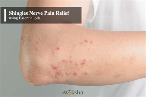 10 Best Essential Oils for Shingles Nerve Pain Relief – Moksha Lifestyle Products