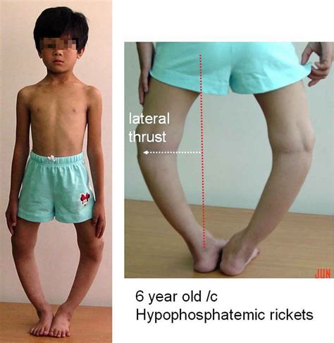 Hypophosphatemic rickets causes, symptoms, diagnosis, treatment & prognosis