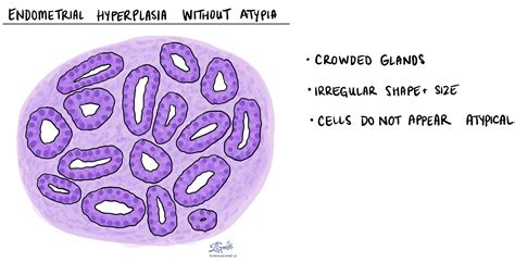 Hiperplasia endometrial sin atipia | MyPathologyReport.ca