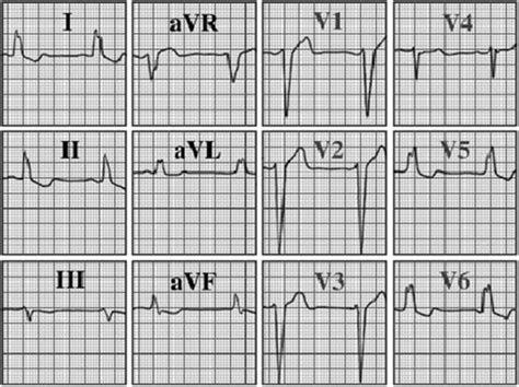 Left Bundle Branch Block (LBBB): ECG Criteria, Causes,, 54% OFF