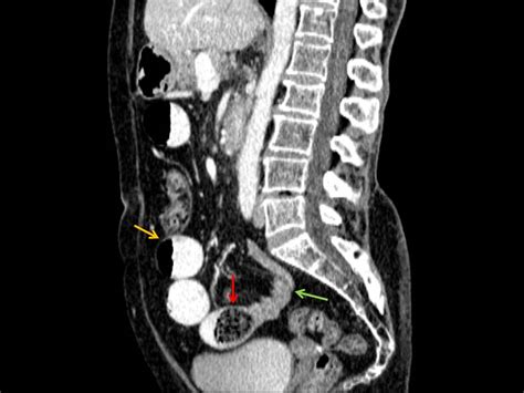 Phytobezoar | Image | Radiopaedia.org