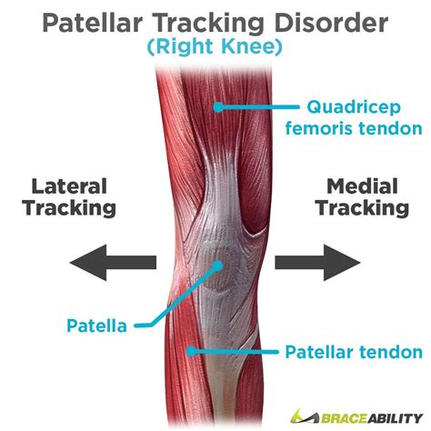 Patellar Tracking Disorder-Symptoms, Causes, Treatment and Prevention - 9INE POINT