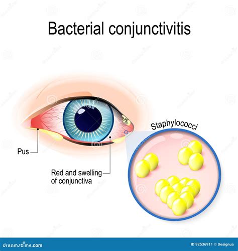 Conjunctivitis Cartoon Vector | CartoonDealer.com #24711945