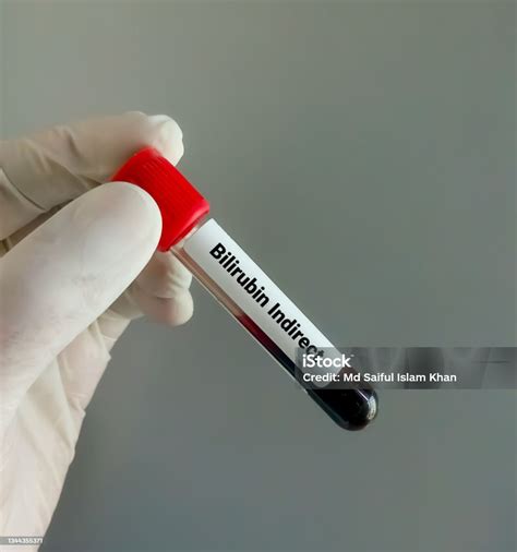 Scientist Hold Blood Samples For Indirect Bilirubin Test Jaundice ...