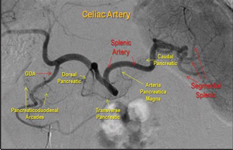 Endovascular Today - Minimally Invasive Interventions for Nontraumatic Splenic Disorders ...